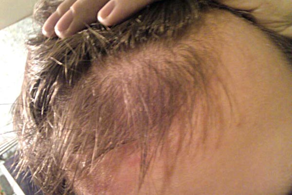диффузное-выпадение-волос2